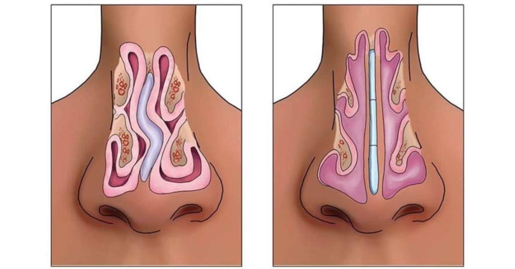 Como a septoplastia corrige um septo nasal desviado