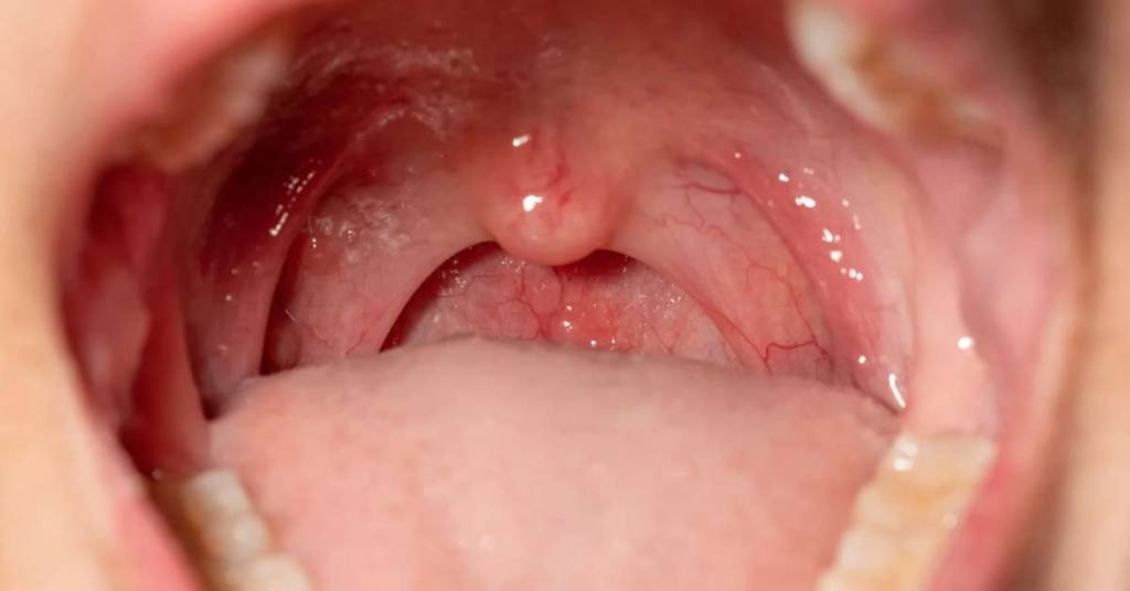 Principais causas de inflamação das amígdalas