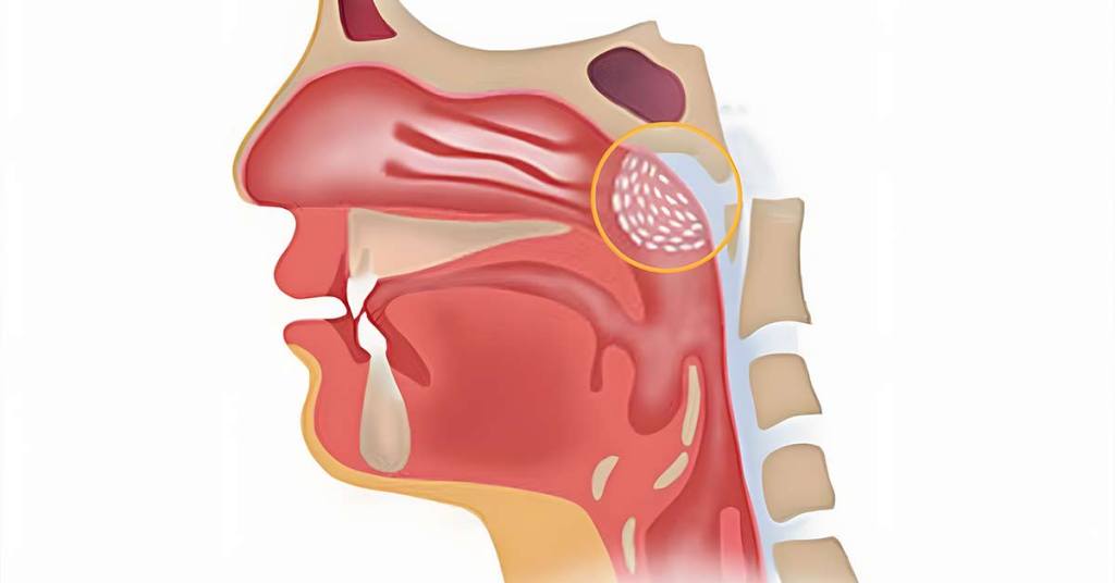 Quais são os sintomas de adenoides inflamadas