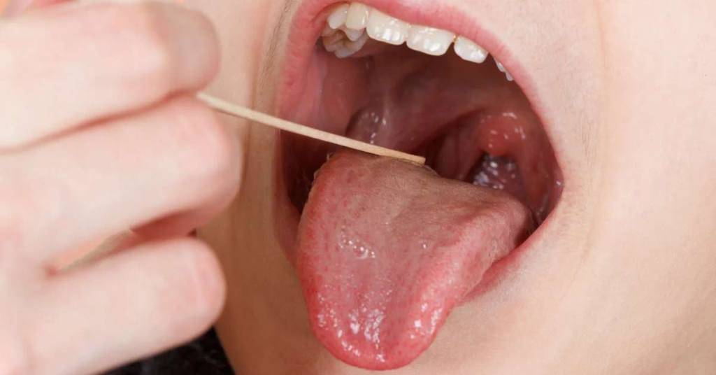 Quando é recomendado remover as amígdalas