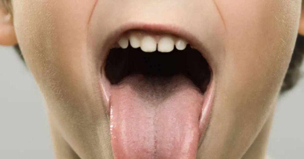 Benefícios da remoção de amígdalas e adenoides para crianças e adultos