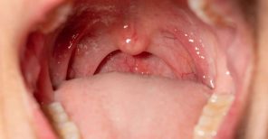 Amigdalectomia para tratamento de dor de garganta crônica