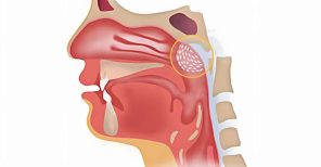 Quais são os sintomas de adenoides inflamadas